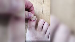 Make Me Suffer More: Pulling off an ingrown toenail. #2