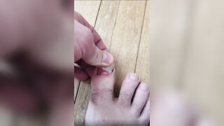 Make Me Suffer More: Pulling off an ingrown toenail. #4