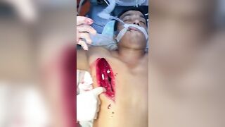 Removing half a saw, from a man's body